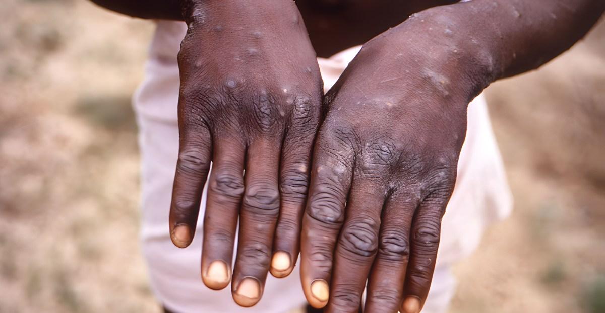 The mpox outbreak never ended in Africa. Now a deadlier strain is spreading.