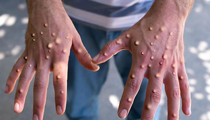 خیبر پختونخوا میں منکی پاکس کے مزید 2کیسز ،ملک بھر میں تشویش کی لہر