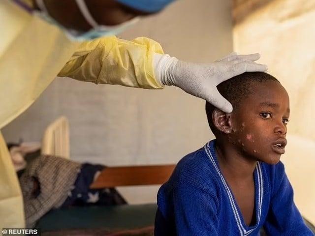 برطانیہ میں بھی  منکی پاکس کے حوالے سے ہائی الرٹ جاری