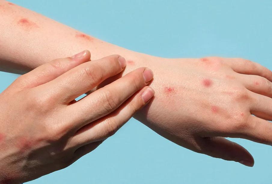 پاکستان میں منکی پاکس کا ایک اورکیس، ملک میں تشویش کی لہر