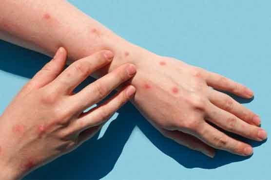 کراچی ائیرپورٹ پر منکی پاکس کے مزید کیسز سامنے آگئے