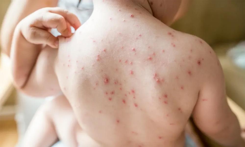 Measles worsens again in Karachi, children admitted to hospitals