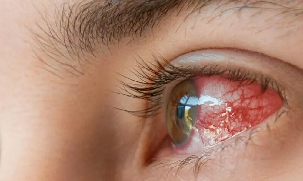 Conjunctivitis outbreak in Peshawar due to flood situation
