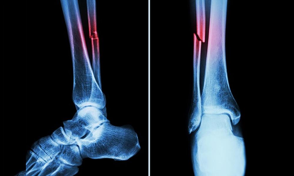 Superglue formed to heal fractures in minutes