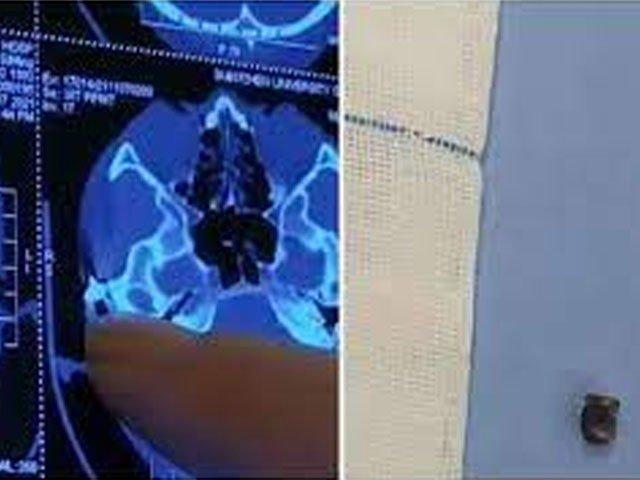 20 سال قبل ائیر گن سے لگنے والی گولی  آخر کار سرسے نکال لی گئی