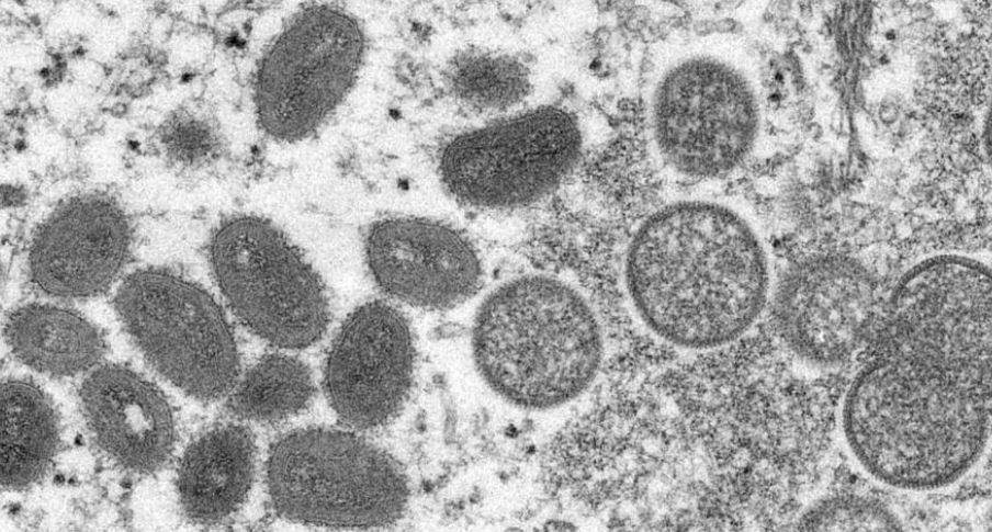 Second Mpox case reported in Karachi