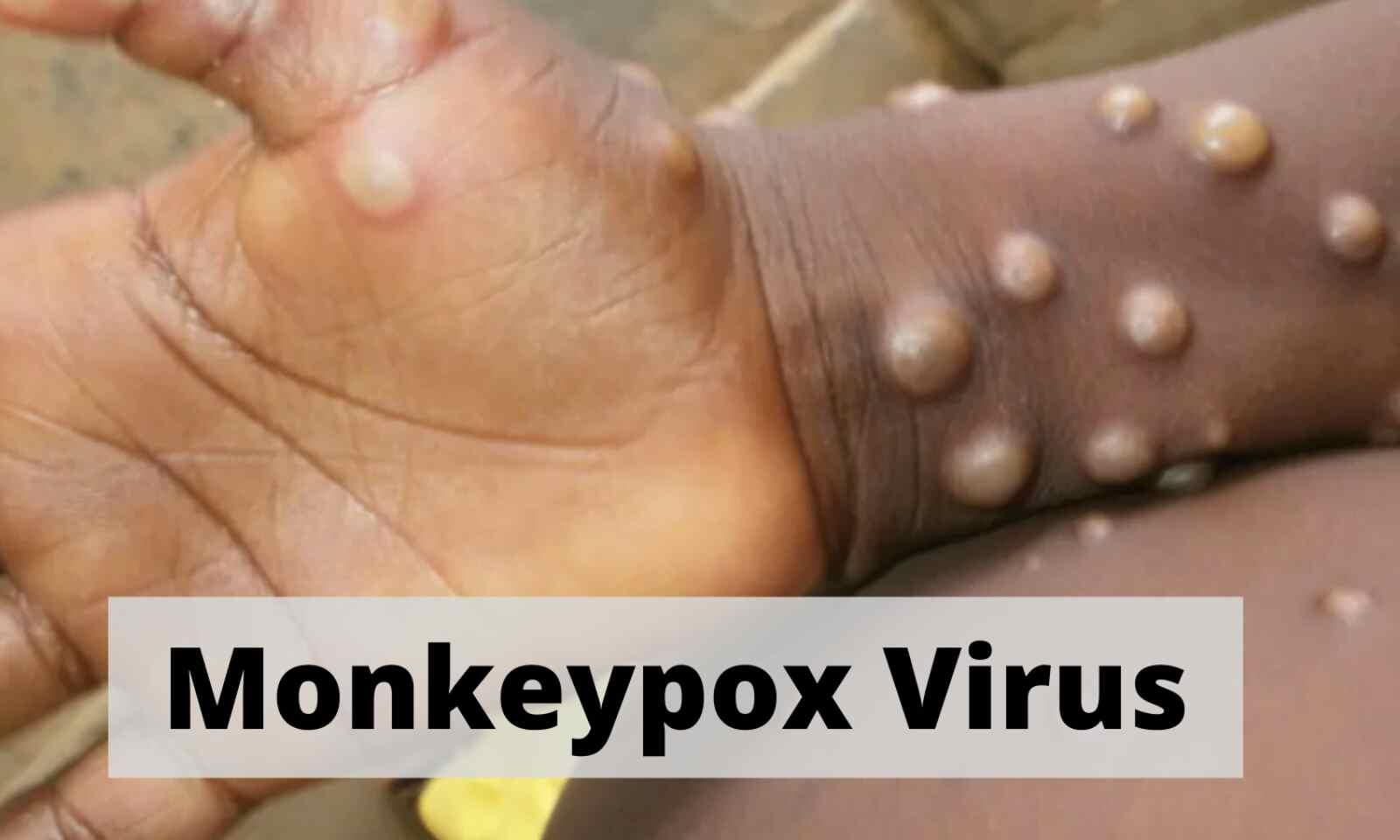 More than 200 cases of monkeypox worldwide: EU disease agency