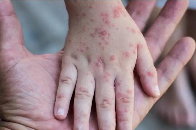 منکی پاکس کا خطرہ، ملک کے داخلی راستوں پر سخت نگرانی شروع