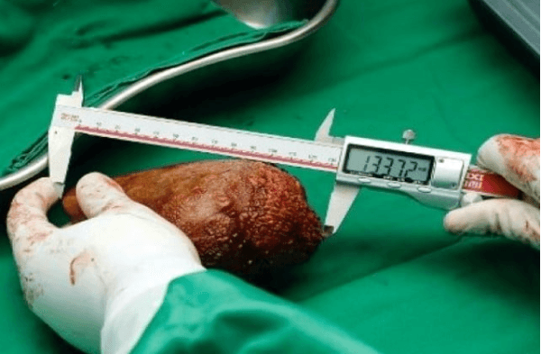 سری لنکا کے مریض کے گُردے سے اب تک کی سب سے بڑی پتھری نکال لی گئی