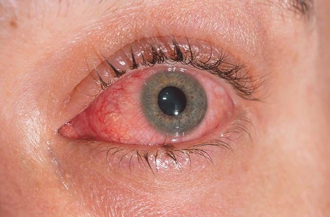 Conjunctivitis epidemic increases in Karachi