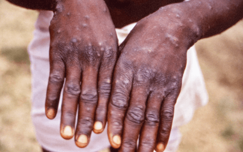 Monkey Pox disease resurfaces in Pakistan 