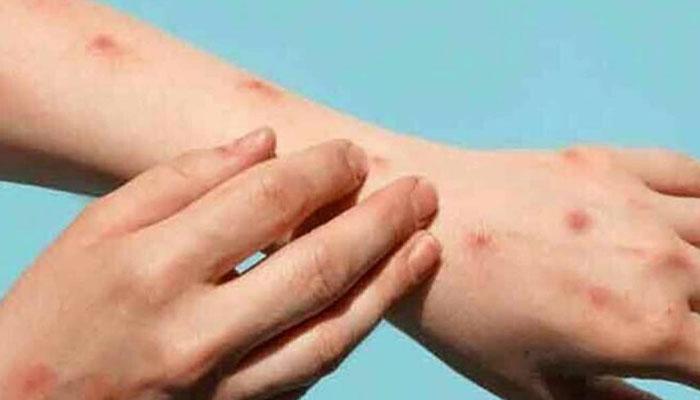 11 chicken pox cases reported in Peshawar