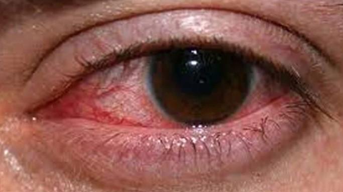 Conjunctivitis cases surge in Lahore following Karachi