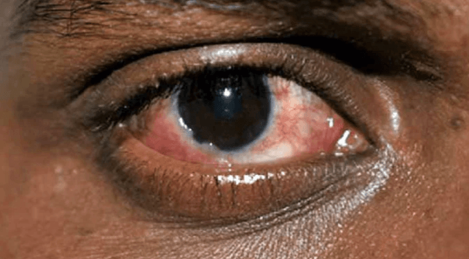 Punjab faces growing cases of vision loss due to injections