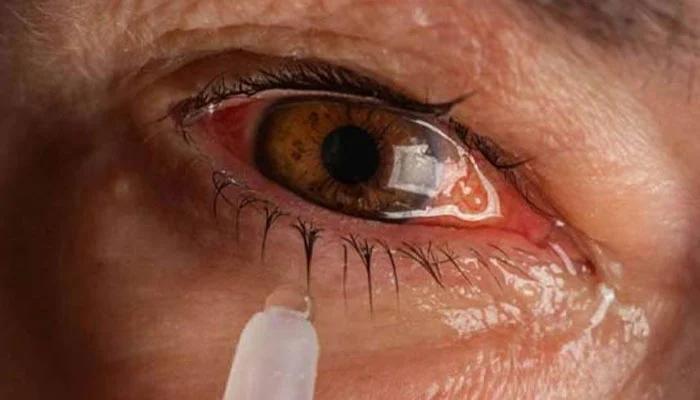 Number of conjunctivitis patients in Punjab reaches 100,000