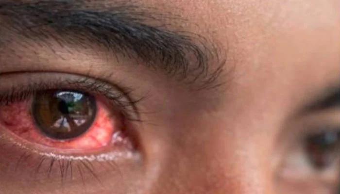 Over 9000 new conjunctivitis cases reported in Punjab