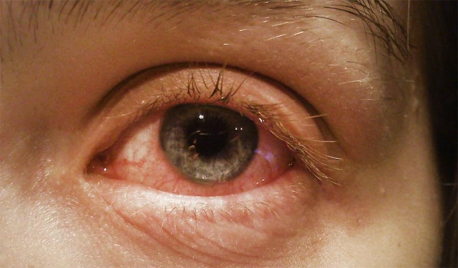 این آئی ایچ کی جانب سے آشوب چشم سے متعلق ایڈوائزری جاری