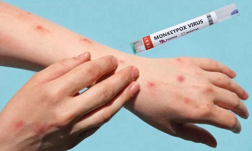 WHO assures providing monkeypox medicine to Pakistan