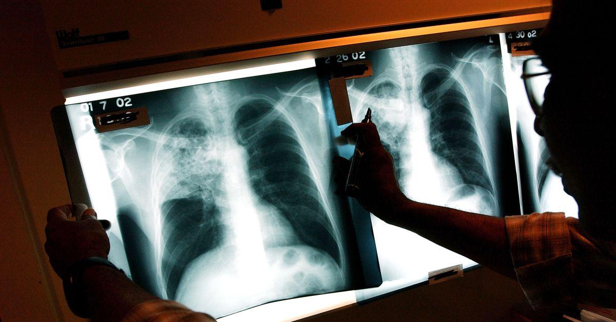 Tuberculosis kills more people than malaria or HIV. Why haven’t we found a vaccine?