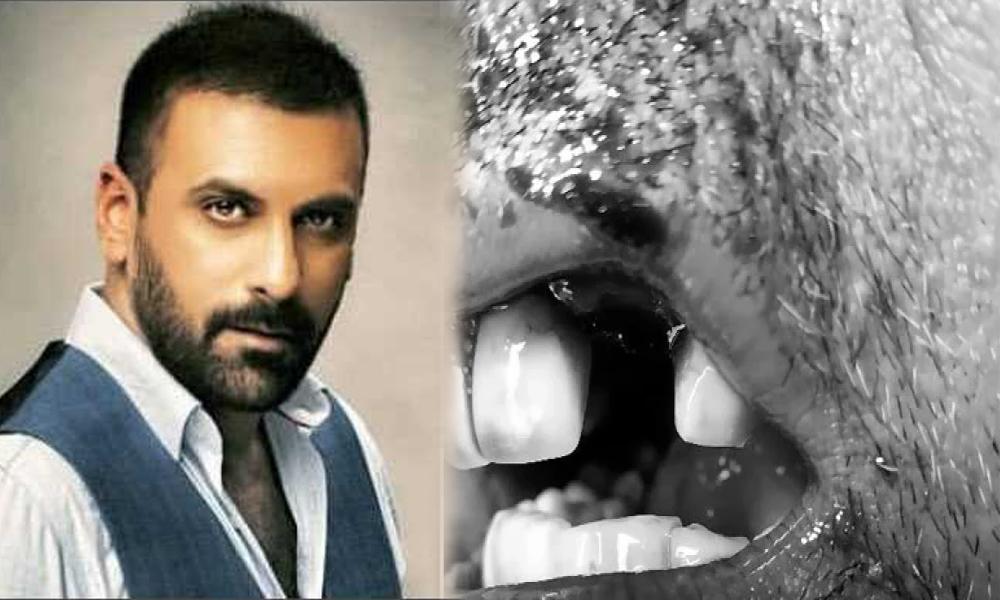 اداکار شمعون عباسی کا حادثے میں دانت ٹوٹ گیا