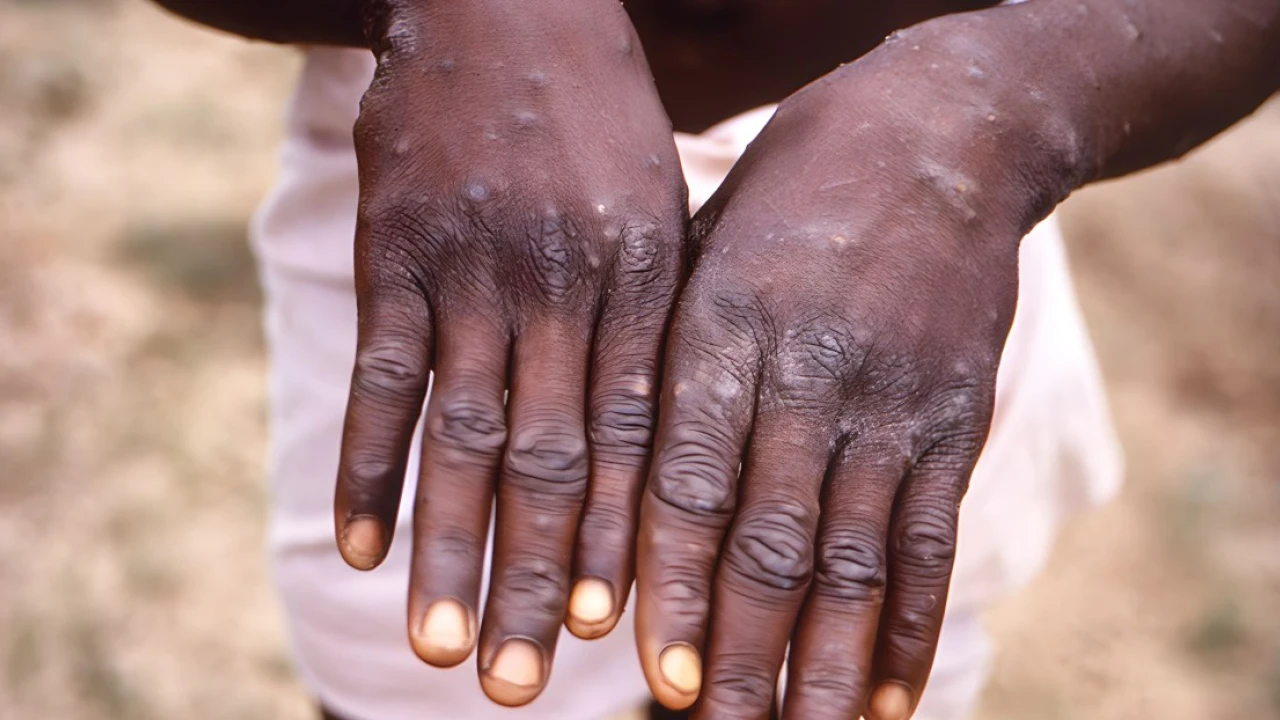 The mpox outbreak never ended in Africa. Now a deadlier strain is spreading.