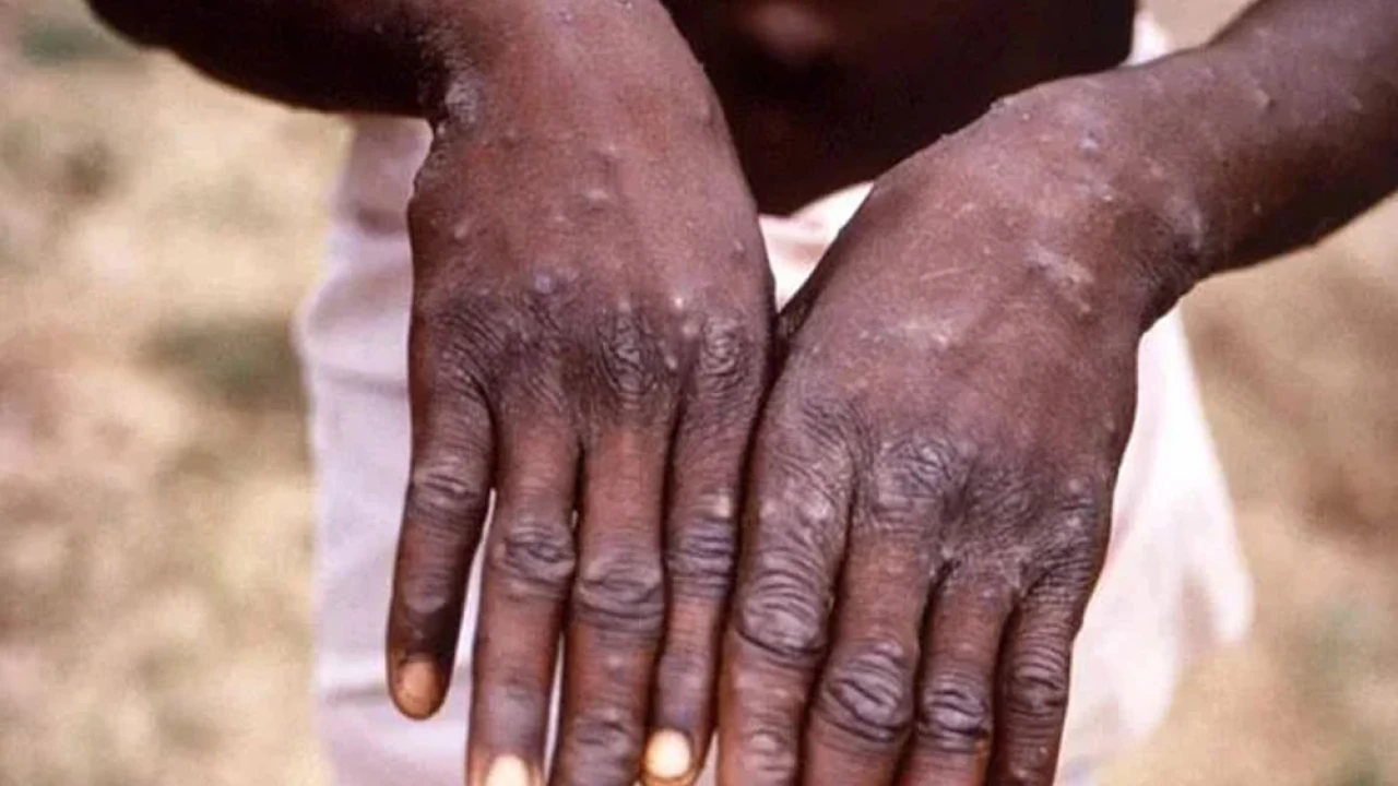 New variant of monkeypox in Africa, WHO warns