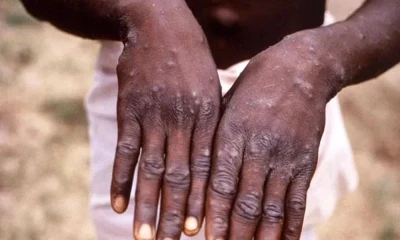 New variant of monkeypox in Africa, WHO warns