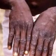 New variant of monkeypox in Africa, WHO warns