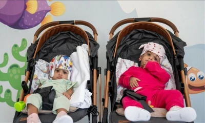 Turkish doctors successfully separate 11-month-old Pakistani conjoined twins