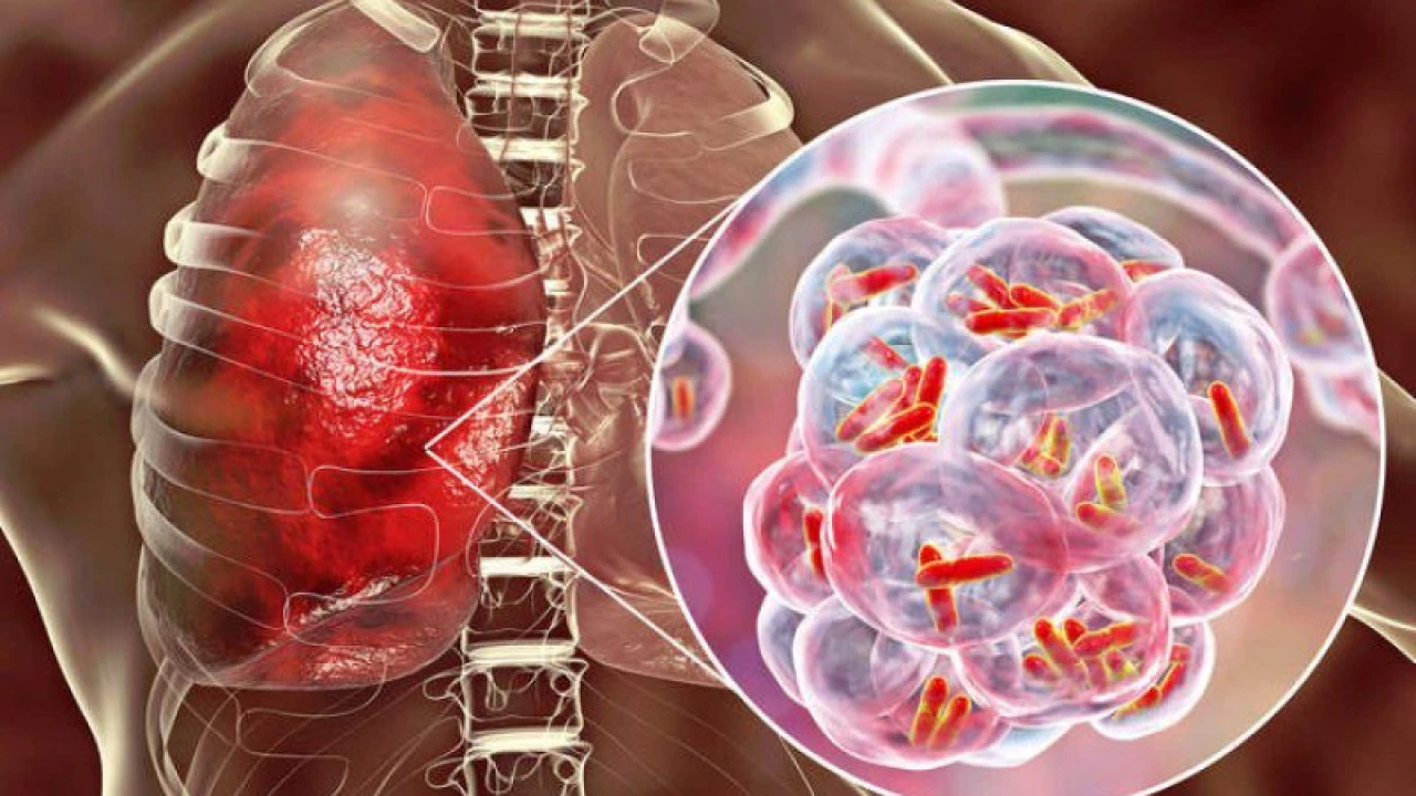 Tuberculosis cases  mjklbhhit record 8.2m high in 2023: WHO