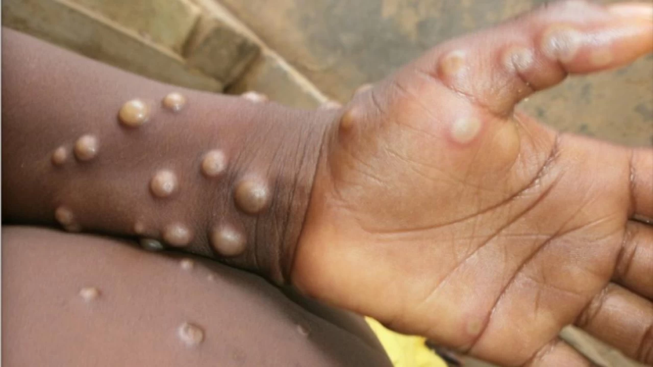 Monkeypox: Portugal reports five cases in men