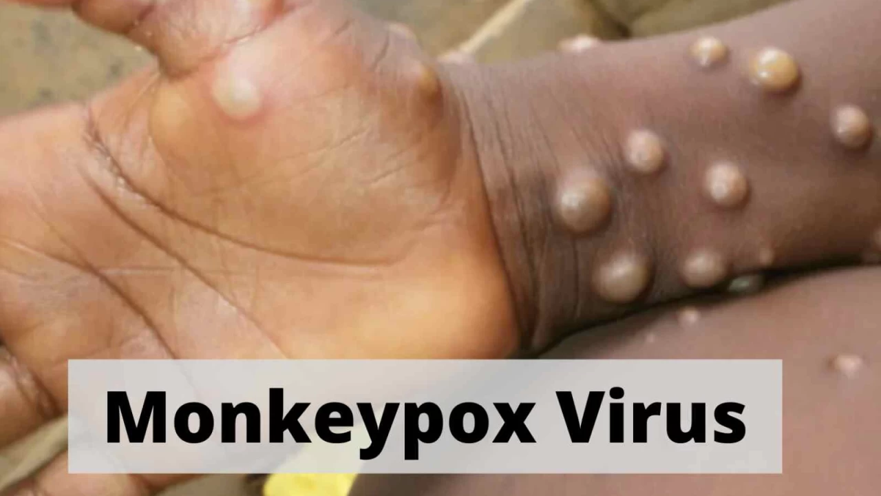 More than 200 cases of monkeypox worldwide: EU disease agency