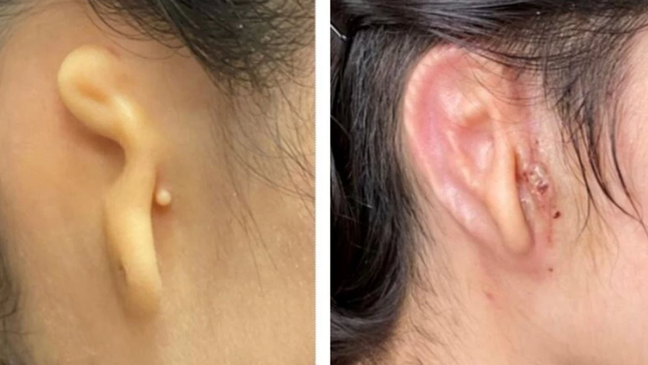 First-of-its-kind: Mexico Woman gets 3D printed ear implant