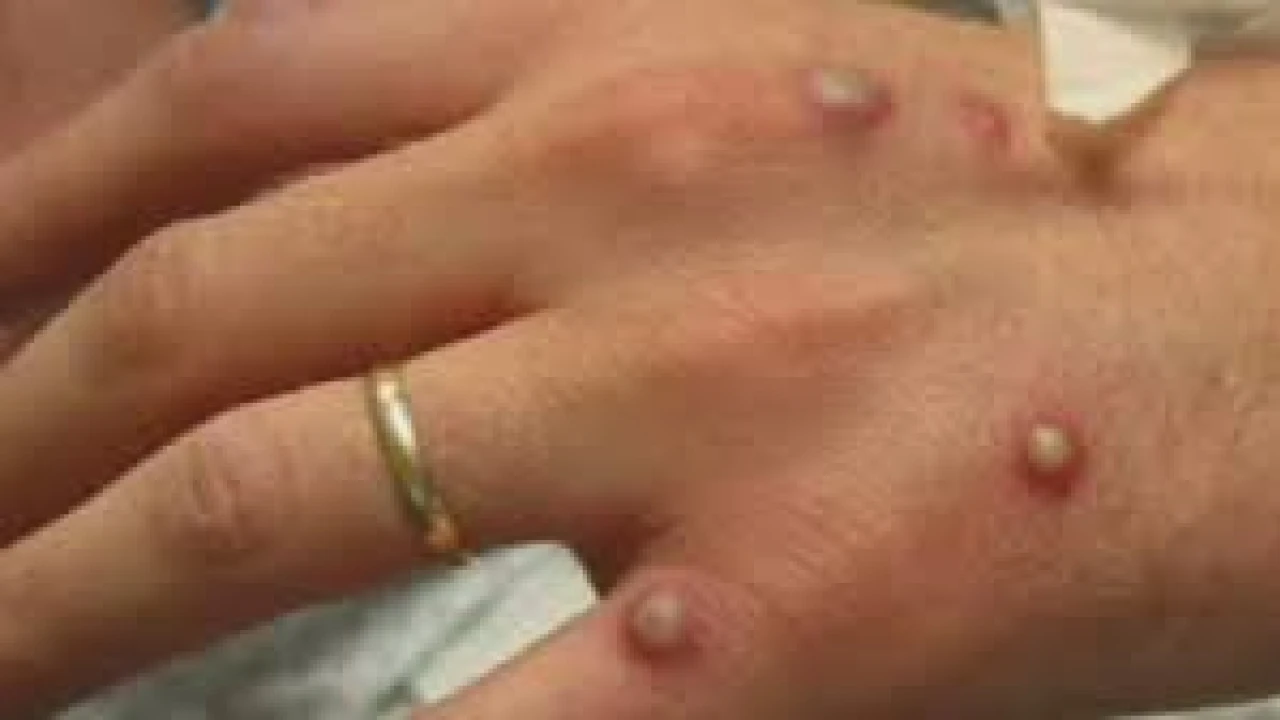 Pakistan reports two cases of Monkeypox virus