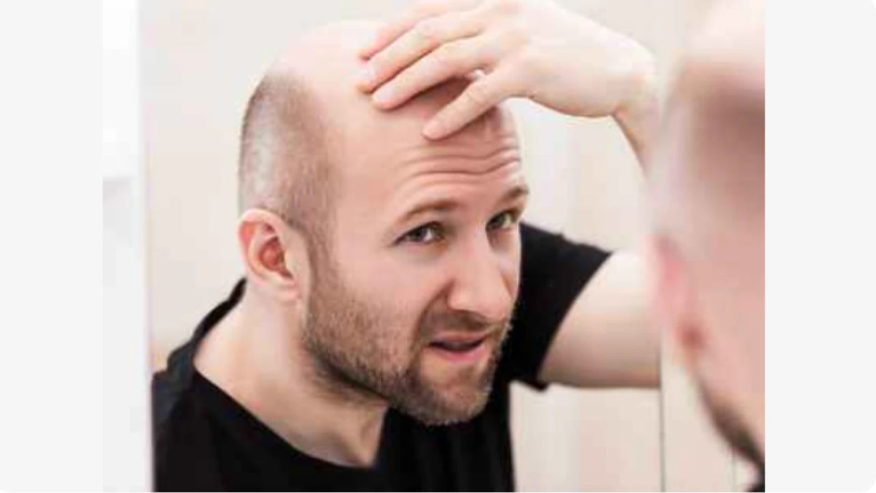 New drug approved to treat baldness