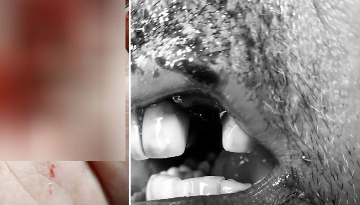 Actor Shamonn Abbasi breaks tooth in accident - Vimarsana News