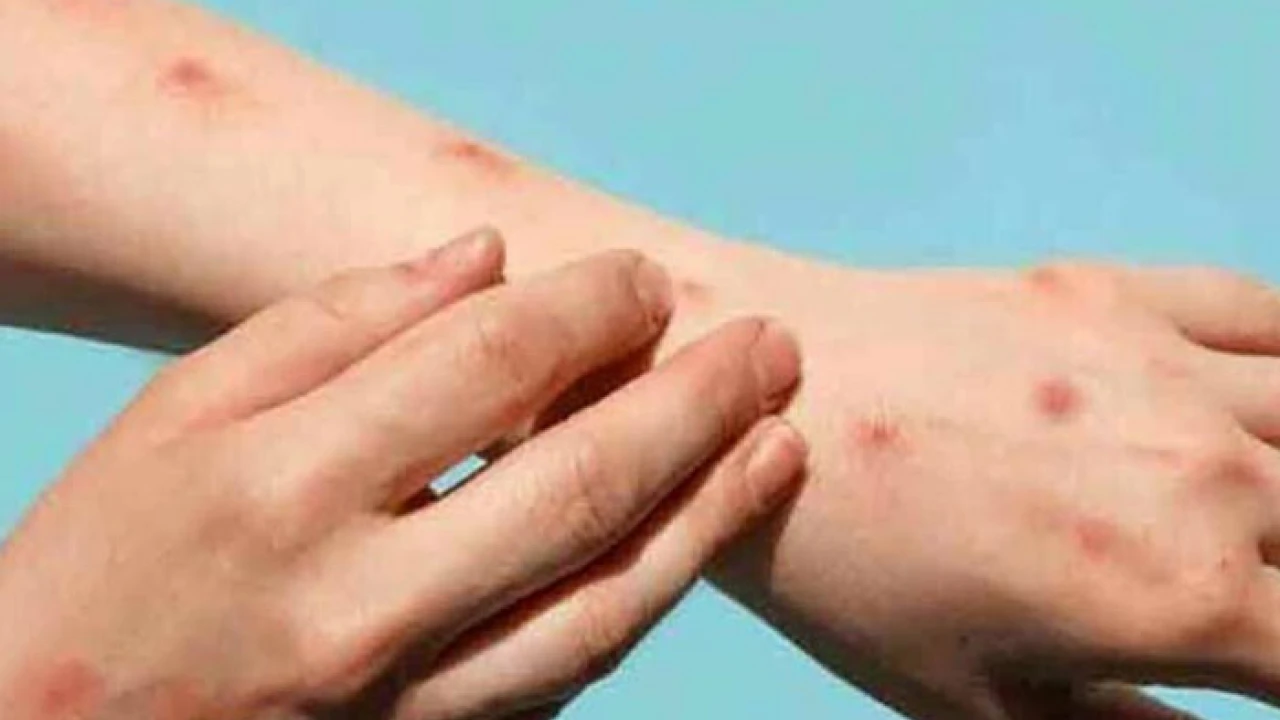 11 chicken pox cases reported in Peshawar