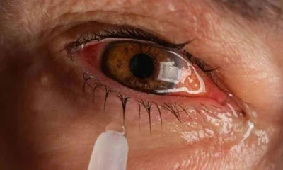 Number of conjunctivitis patients in Punjab reaches 100,000