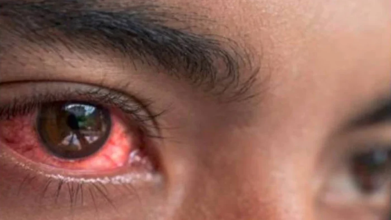 Over 9000 new conjunctivitis cases reported in Punjab