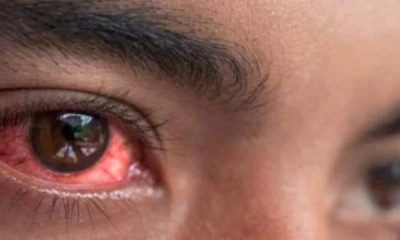 Over 9000 new conjunctivitis cases reported in Punjab