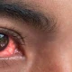 Over 9000 new conjunctivitis cases reported in Punjab