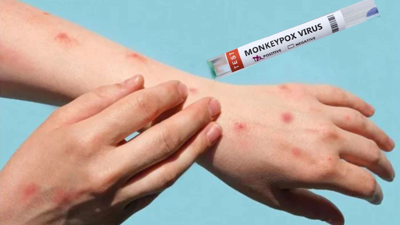 WHO assures providing monkeypox medicine to Pakistan