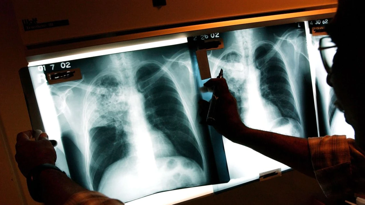 Tuberculosis kills more people than malaria or HIV. Why haven’t we found a vaccine?